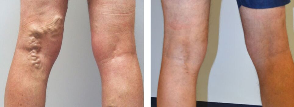 Imagen antes y después de usar Veniselle, experimente el uso de crema