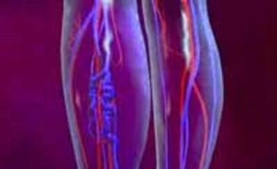 Las causas y el tratamiento de las venas varicosas