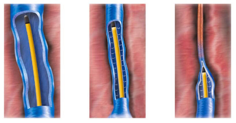 La ablación por radiofrecuencia como método para tratar las venas varicosas.