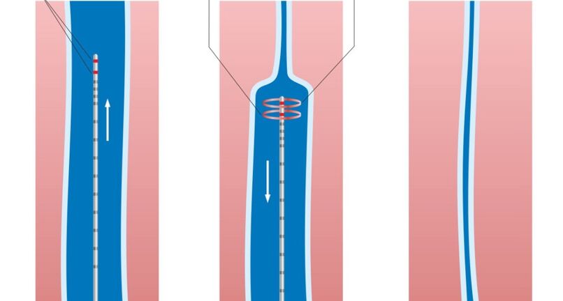 Tratamiento con láser para las varices de las piernas.